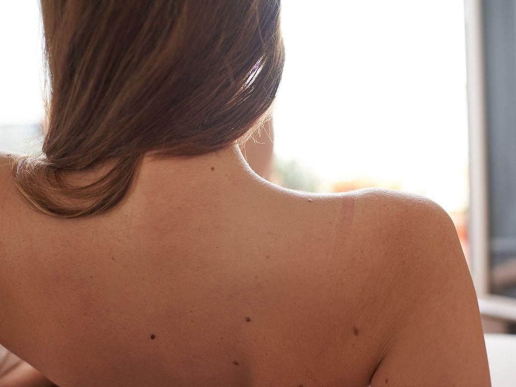 Hautkrebs-Screening: Nackter Rücken einer Frau.